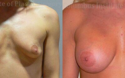 Breast Augmentation before and after photo by Columbus Institute of Plastic Surgery in Columbus, OH