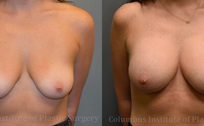 Breast Augmentation before and after photo by Columbus Institute of Plastic Surgery in Columbus, OH