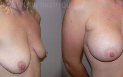 Breast Augmentation before and after photo by Columbus Institute of Plastic Surgery in Columbus, OH