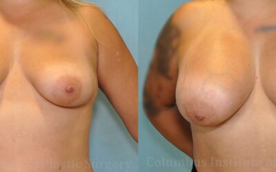 Breast Augmentation before and after photo by Columbus Institute of Plastic Surgery in Columbus, OH