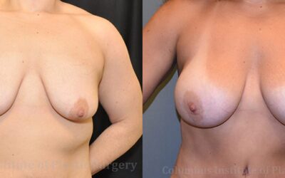 Breast Augmentation before and after photo by Columbus Institute of Plastic Surgery in Columbus, OH