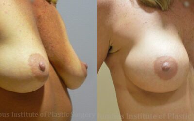 Breast Augmentation before and after photo by Columbus Institute of Plastic Surgery in Columbus, OH