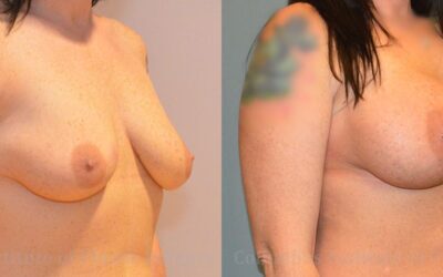 Breast Augmentation before and after photo by Columbus Institute of Plastic Surgery in Columbus, OH