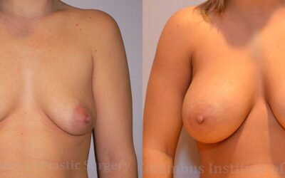 Breast Augmentation before and after photo by Columbus Institute of Plastic Surgery in Columbus, OH