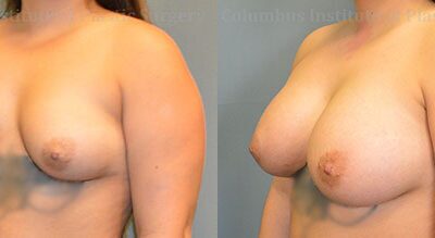 Breast Augmentation before and after photo by Columbus Institute of Plastic Surgery in Columbus, OH