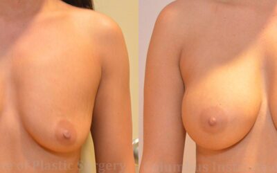 Breast Augmentation before and after photo by Columbus Institute of Plastic Surgery in Columbus, OH