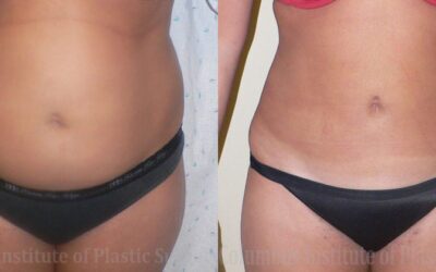 Liposuction before and after photo by Columbus Institute of Plastic Surgery in Columbus, OH