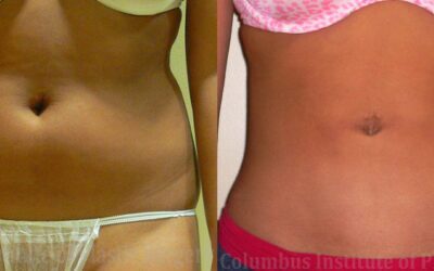 Liposuction before and after photo by Columbus Institute of Plastic Surgery in Columbus, OH