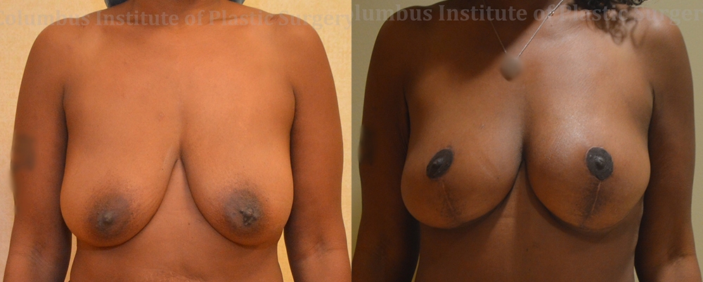 Breast Lift (Mastopexy) before and after photo by Columbus Institute of Plastic Surgery in Columbus, OH