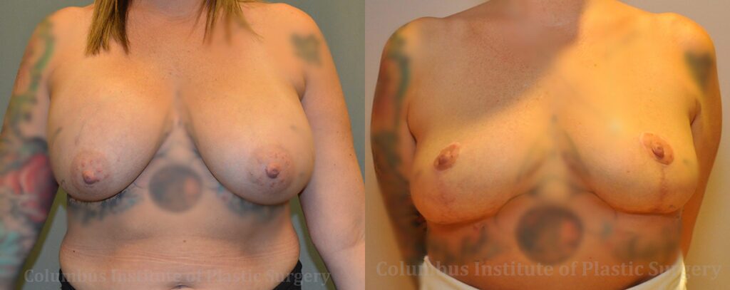 Breast Lift (Mastopexy) before and after photo by Columbus Institute of Plastic Surgery in Columbus, OH