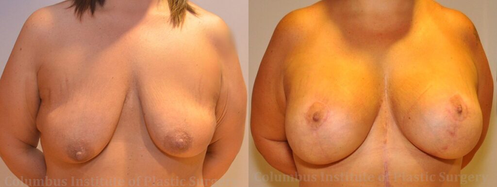 Breast Lift (Mastopexy) before and after photo by Columbus Institute of Plastic Surgery in Columbus, OH