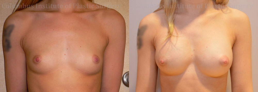 Breast Augmentation – 200cc-300cc before and after photo by Columbus Institute of Plastic Surgery in Columbus, OH