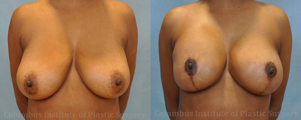 Breast Lift and Augmentation (Implants) before and after photo by Columbus Institute of Plastic Surgery in Columbus, OH