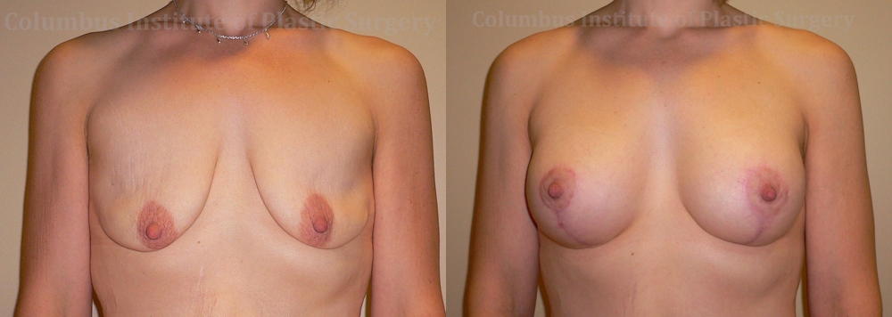 Breast Lift and Augmentation (Implants) before and after photo by Columbus Institute of Plastic Surgery in Columbus, OH