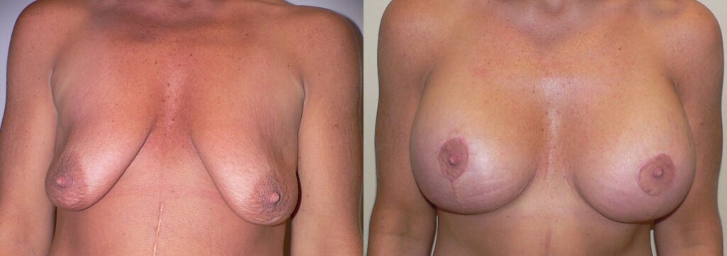 Breast Lift and Augmentation (Implants) before and after photo by Columbus Institute of Plastic Surgery in Columbus, OH