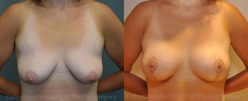 Breast Lift and Augmentation (Implants) before and after photo by Columbus Institute of Plastic Surgery in Columbus, OH
