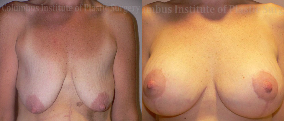 Breast Lift with Augmentation after Weight Loss before and after photo by Columbus Institute of Plastic Surgery in Columbus, OH
