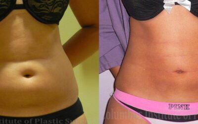 Liposuction before and after photo by Columbus Institute of Plastic Surgery in Columbus, OH