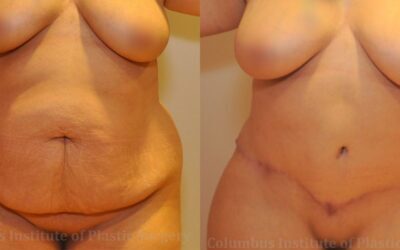 Liposuction before and after photo by Columbus Institute of Plastic Surgery in Columbus, OH