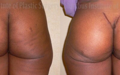 Buttock (Gluteal) Augmentation with Implants before and after photo by Columbus Institute of Plastic Surgery in Columbus, OH