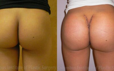 Buttock (Gluteal) Augmentation with Implants before and after photo by Columbus Institute of Plastic Surgery in Columbus, OH