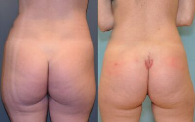 Buttock (Gluteal) Augmentation with Implants before and after photo by Columbus Institute of Plastic Surgery in Columbus, OH