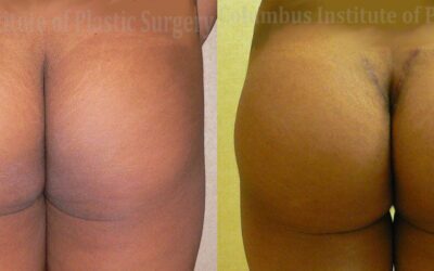 Buttock (Gluteal) Augmentation with Implants before and after photo by Columbus Institute of Plastic Surgery in Columbus, OH