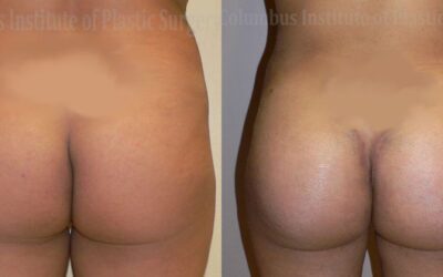Buttock (Gluteal) Augmentation with Implants before and after photo by Columbus Institute of Plastic Surgery in Columbus, OH
