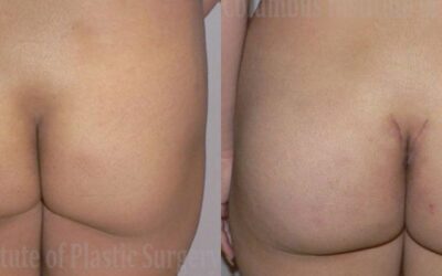 Buttock (Gluteal) Augmentation with Implants before and after photo by Columbus Institute of Plastic Surgery in Columbus, OH