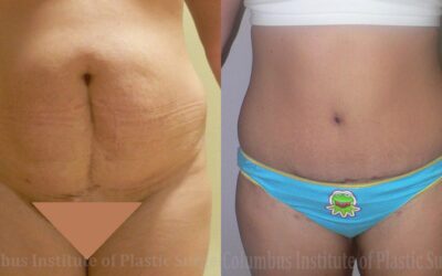 Liposuction before and after photo by Columbus Institute of Plastic Surgery in Columbus, OH