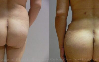 Gluteal (Butt) Augmentation with Fat Grafting (Brazilian Butt Lift) before and after photo by Columbus Institute of Plastic Surgery in Columbus, OH