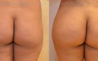 Gluteal (Butt) Augmentation with Fat Grafting (Brazilian Butt Lift) before and after photo by Columbus Institute of Plastic Surgery in Columbus, OH