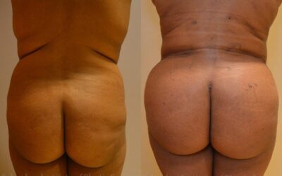 Gluteal (Butt) Augmentation with Fat Grafting (Brazilian Butt Lift) before and after photo by Columbus Institute of Plastic Surgery in Columbus, OH