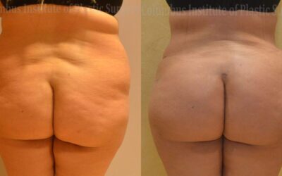 Gluteal (Butt) Augmentation with Fat Grafting (Brazilian Butt Lift) before and after photo by Columbus Institute of Plastic Surgery in Columbus, OH