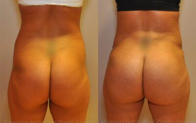 Gluteal (Butt) Augmentation with Fat Grafting (Brazilian Butt Lift) before and after photo by Columbus Institute of Plastic Surgery in Columbus, OH