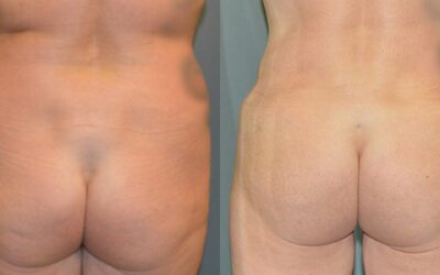 Gluteal (Butt) Augmentation with Fat Grafting (Brazilian Butt Lift) before and after photo by Columbus Institute of Plastic Surgery in Columbus, OH