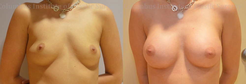 Breast Augmentation – 200cc-300cc before and after photo by Columbus Institute of Plastic Surgery in Columbus, OH