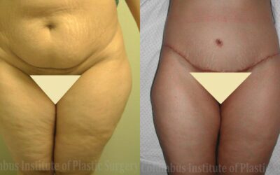 Liposuction before and after photo by Columbus Institute of Plastic Surgery in Columbus, OH