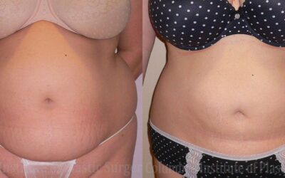 Liposuction before and after photo by Columbus Institute of Plastic Surgery in Columbus, OH