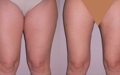 Liposuction before and after photo by Columbus Institute of Plastic Surgery in Columbus, OH
