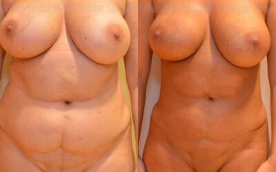 Liposuction before and after photo by Columbus Institute of Plastic Surgery in Columbus, OH